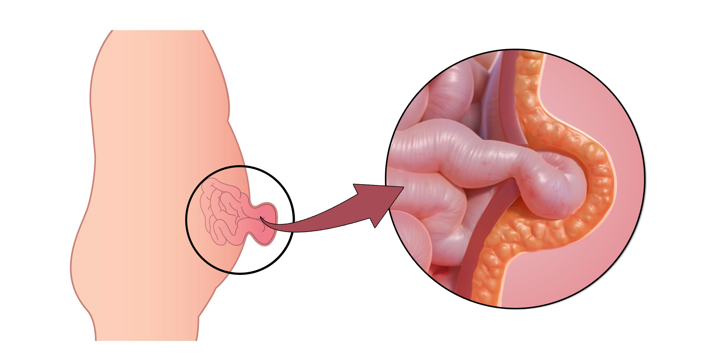 Umbilical hernia exam